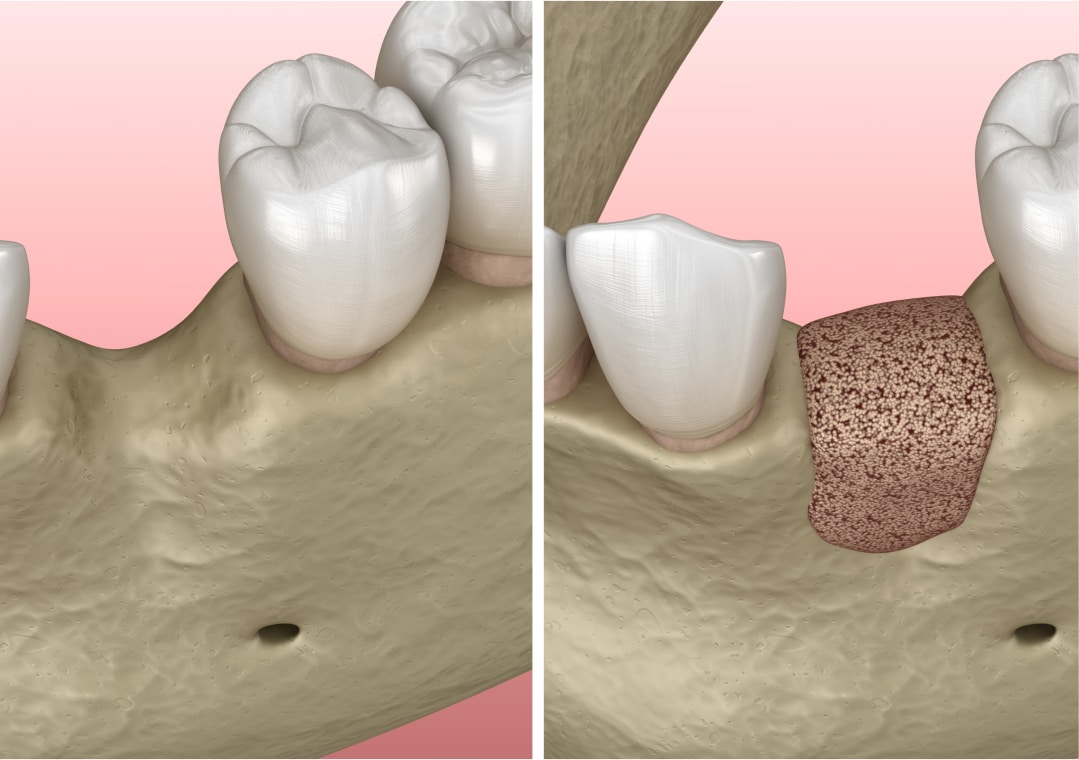 Dentiste-Greffes-Osseuses-Dr-Roulant-Nice