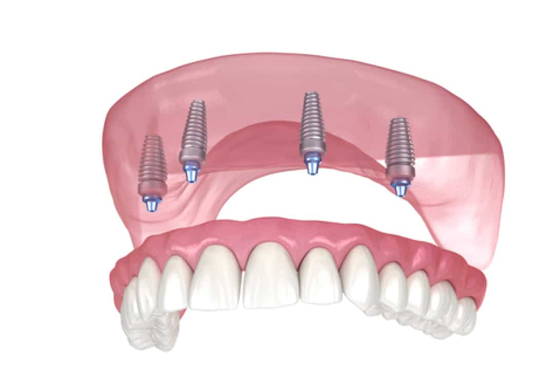 Dentiste-IMPLANTOLOGIE-Cas-Complexe-Dr-Roulant-Nice