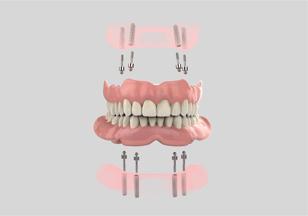 Dentiste-IMPLANTOLOGIE-Cas-Complexe-Simplifié-Dr-Roulant-Nice