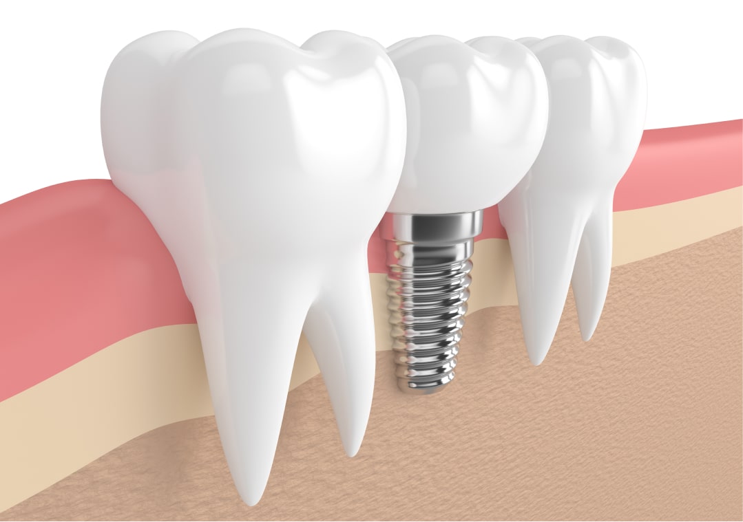 Dentiste-IMPLANTOLOGIE-Dr-Roulant-Nice